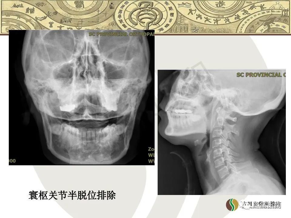 病例分享齿状突加冠综合征