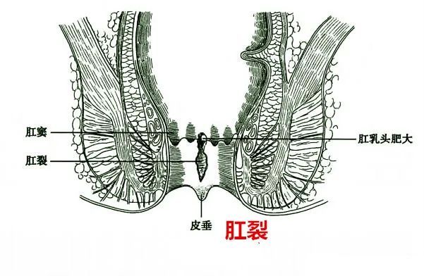 九龙坡肛肠医院推荐:肛裂怎么治?