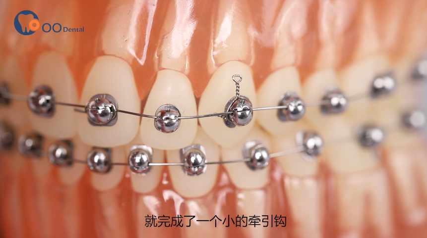 球面自锁托槽操作小技巧牵引钩制作与结扎技巧