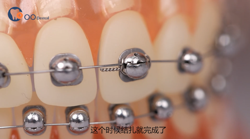 球面自锁托槽结扎操作小技巧单牙结扎与如何预成型