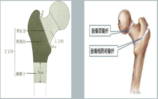 环骨盆创伤病区)接受了股骨粗隆间骨折闭合复位pfna内固定术治疗后