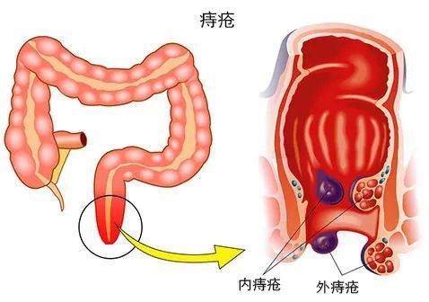 肛门|瘙痒|痔核脱出|痔疮|内痔