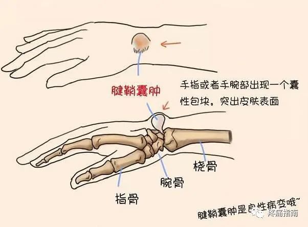 什么是腱鞘囊肿?