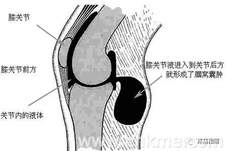 简单点说,腱鞘囊肿是因为反复的劳损,导致关节滑膜腔内滑液产生过多