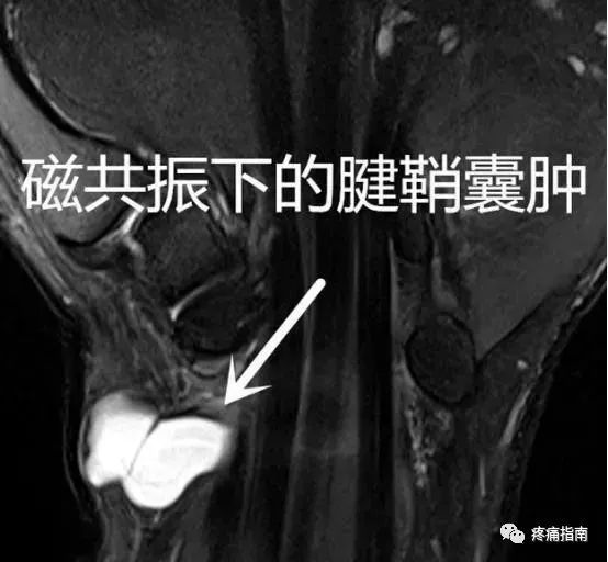 什么是腱鞘囊肿?
