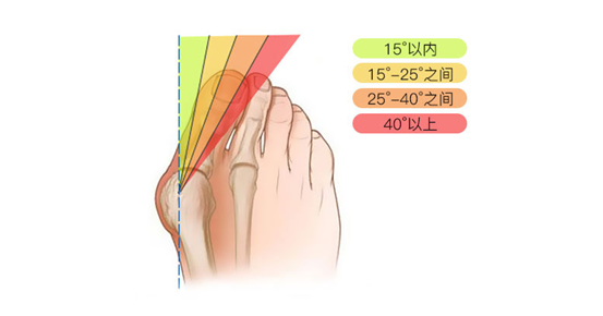 外翻,拇趾旋转,跨趾,跖骨过长或过短,内收肌挛缩,背伸肌腱挛缩,跖趾