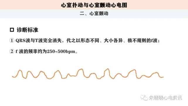 心电图解读:室扑与室颤心电图(ppt)