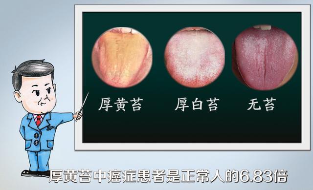 厚黄苔多鼻咽癌,厚白苔多肺癌,还有呢?