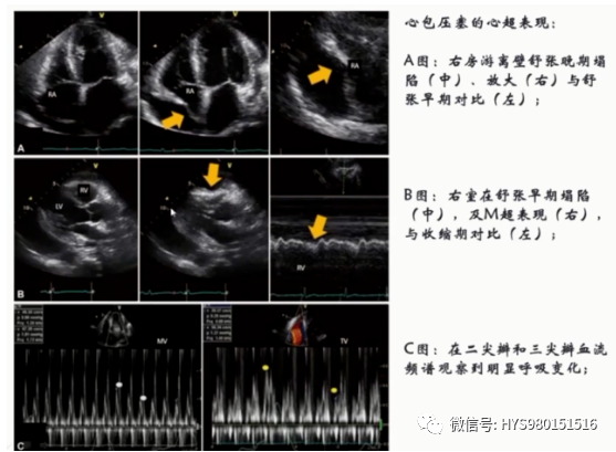关于心包积液需要掌握的干货知识点