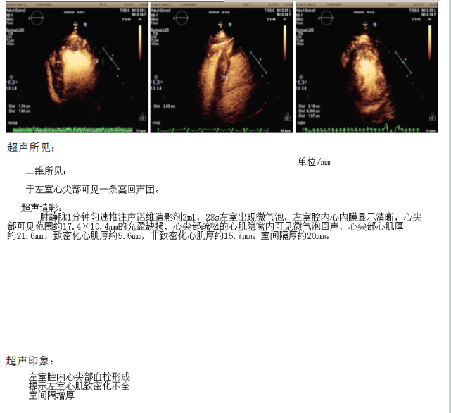 突入心室内的肌小梁和与心室腔交通深陷的隐窝为主要特征的异质性疾病