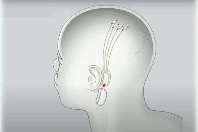 生物黑客：超人、赛博格的诞生记，他们用技术改变与超越自己 | CyberDaily