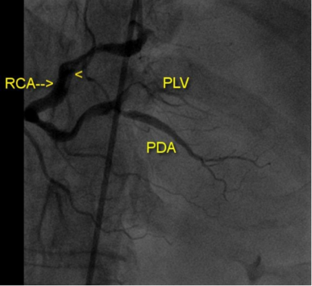 图3 冠脉造影示回旋支,钝缘支病变图2 冠脉造影示前降支病变冠状动脉