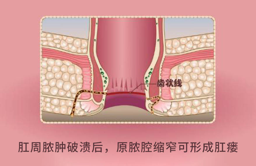 "三少爷"——肛乳头肥大肛乳头肥大:是一种增生性炎症疾病,长期存在有