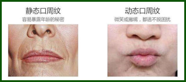 自然衰老所导致的皮肤老化,往往是口周纹形成的主要原因.