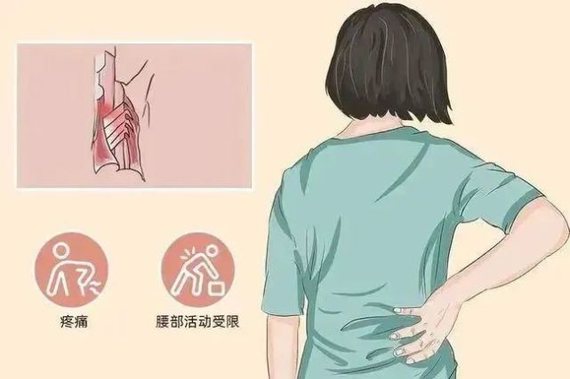 腰肌痉挛 腾讯网