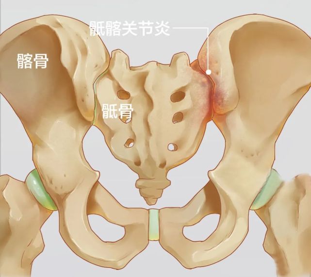症状表现腰骶部疼痛,少数尾骶部,腹股沟疼痛,及一侧或两侧下肢痛.