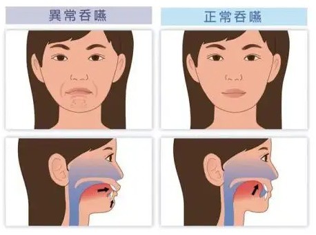 正常吞咽时上下牙接触,舌背与上颌腭部接触,舌尖接触硬腭前份,上切牙