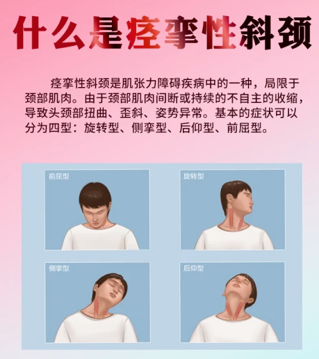 中医治疗痉挛性斜颈效果真的那么好吗要多久能治好呢