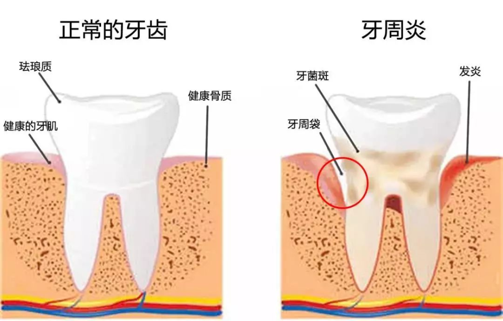 "最常见的口腔疾病之一就是牙周炎,牙周炎不治疗不仅危害口腔健康,更