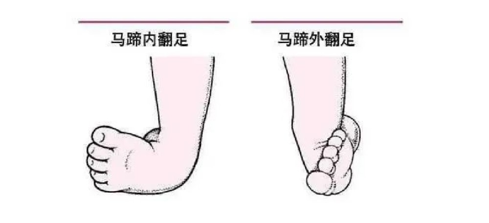 小伙因马蹄足二十多年脚跟不能着地医生不及早治疗或致严重残疾