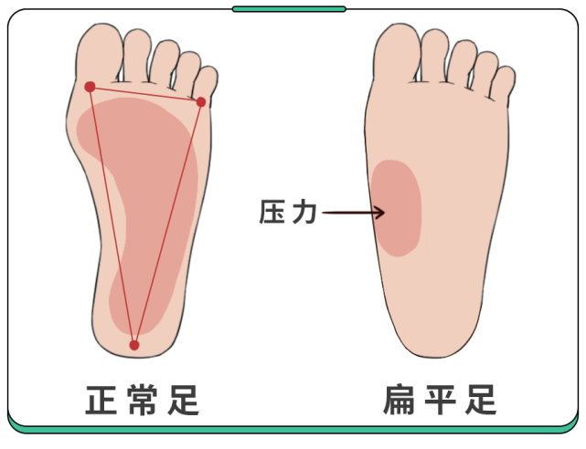 孩子扁平足伴随这几种异常有脊柱侧弯驼背的风险