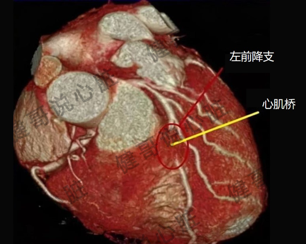 健哥说心脏有声版心脏这座桥你了解吗