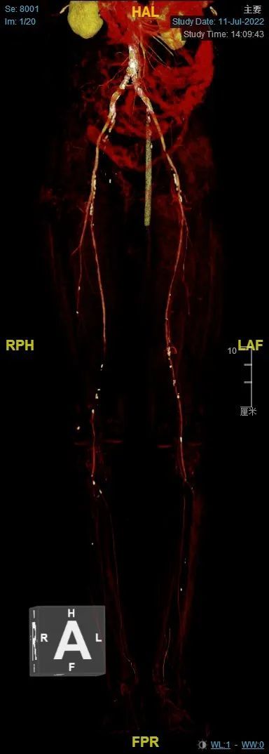双下肢动脉cta提示双下肢aso,右下肢股浅中远端及腘动脉p1段闭塞,双