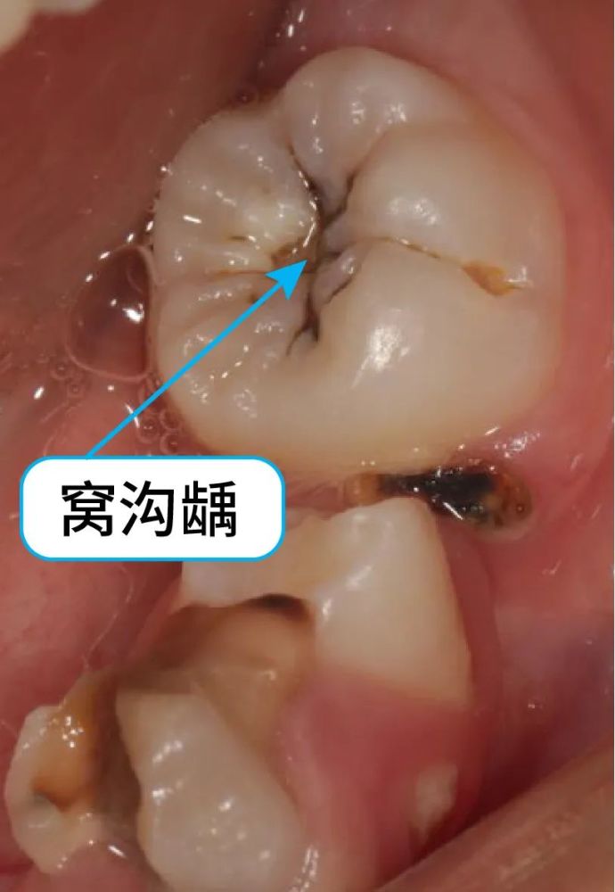 窝沟封闭是预防窝沟龋坏最有效的方法你家小孩做了吗