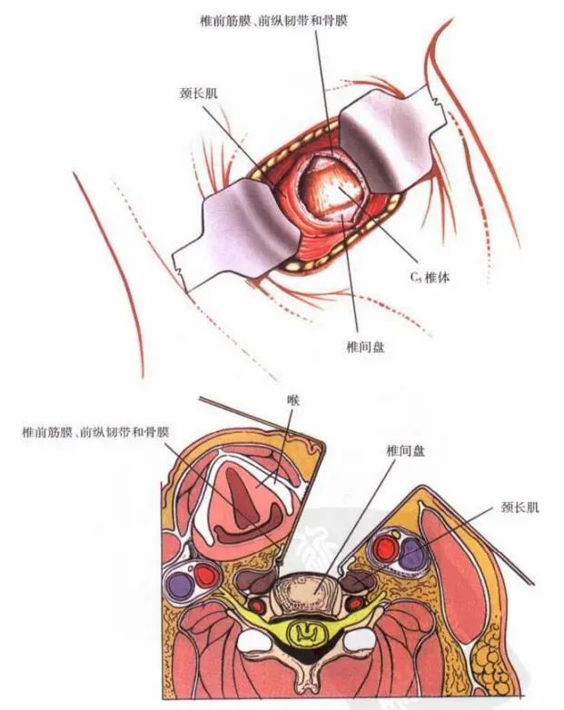 图4 将胸锁乳突肌牵向外侧,带状肌和甲状腺结构牵向内侧.