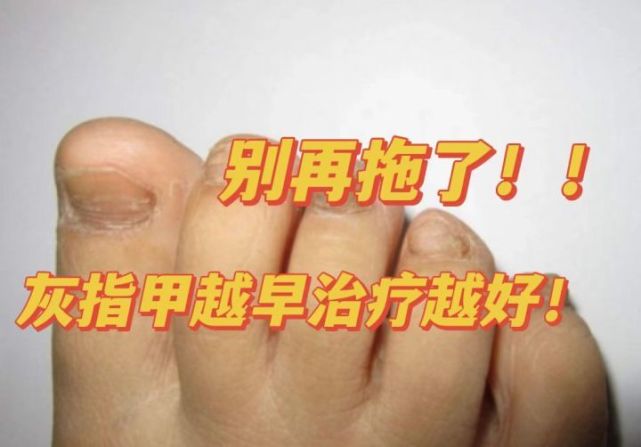 指甲泛黄增厚反复发作?过来人一招摆脱灰指甲!