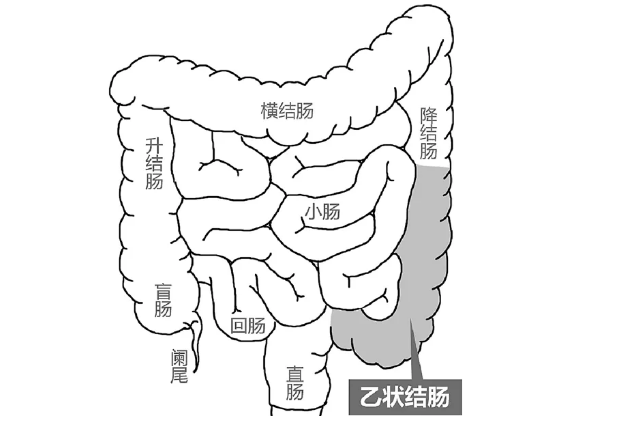 乙状结肠息肉肠镜多久做一次