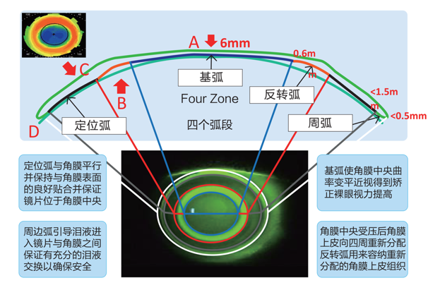 角膜塑形镜镜通过较长时间的配戴,改变角膜原有形态,使角膜中央区域的