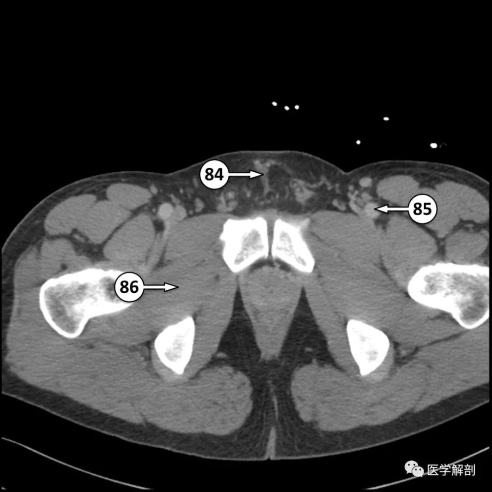 阴茎悬韧带85.左股总动脉86.闭孔外肌权威医学解剖公众号