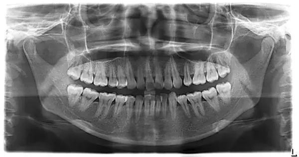 dental像拔智齿,补牙,做根管治疗(牙痛,牙周