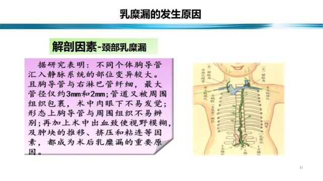 【课件】翟军亚(河南省肿瘤:恶性肿瘤淋巴清扫术后乳糜漏的营养管理