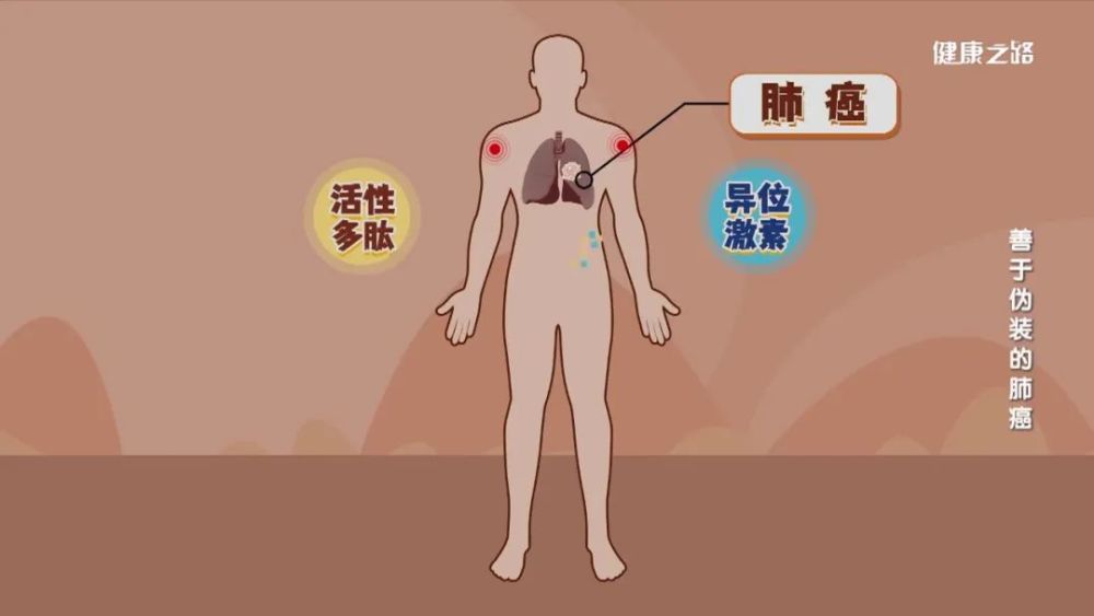 肺癌引发的肩膀疼不随天气变化而变化,疼痛不分时间,且无法通过针灸