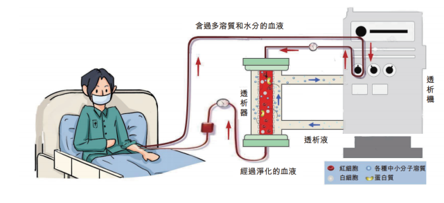 其工作原理是将血液引至体外,借助透析器实现血液与透析液物质交换