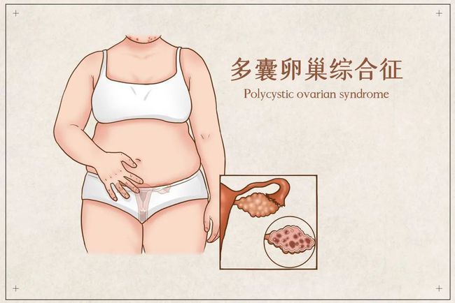 资讯长沙芙蓉湘城医院文静多囊卵巢综合症原因包括哪些