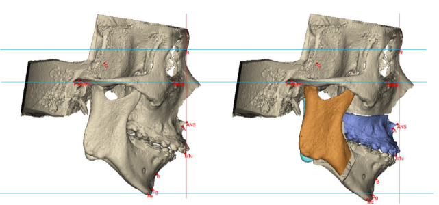 相较于传统模型外科,数字化技术将颌骨异常位置与异常值使用数据量化