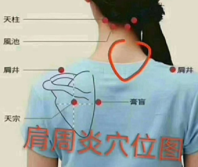 实肩周炎一般是肩周位置因炎症发生疼痛所导致,通常情况下,患有肩周炎