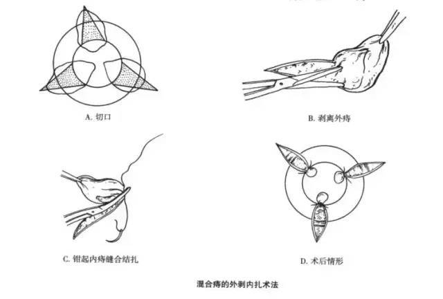 外剥内扎术 腾讯网