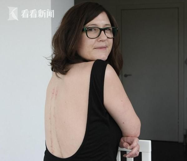 想起来都疼，女子为治病每周被蜜蜂蜇30次 (组图)