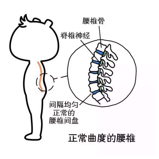 腰椎生理曲度变直又称"腰椎曲度变直,是各种腰椎疾病常伴有的腰椎