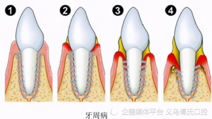 牙周病的典型症状和治疗方法