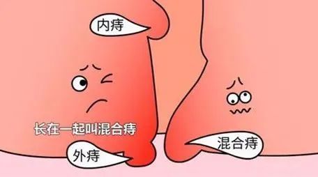 大二男生竟天天用卫生棉痔疮是怎么引起的4招远离痔疮