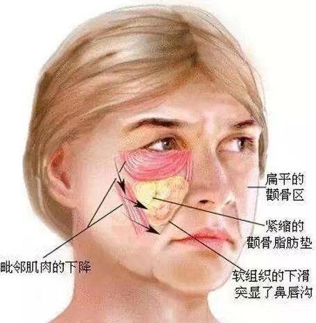 郑州美莱科普面部苹果肌的饱满与哪些因素有关