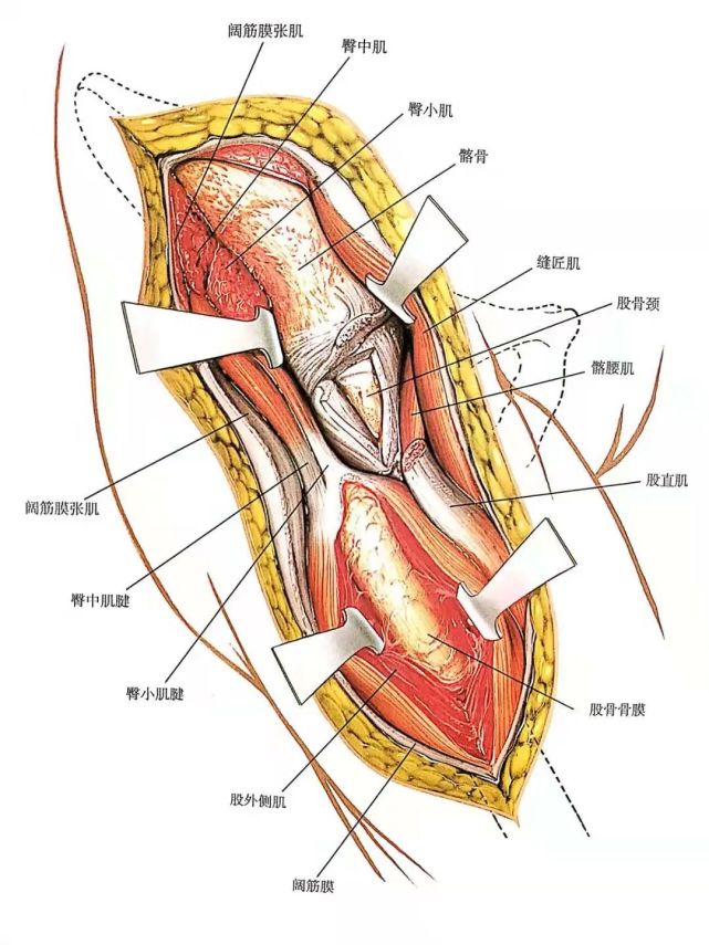 b:向近端延长切口显露髂骨,向远端延长切口显露位于股外侧肌和股直肌