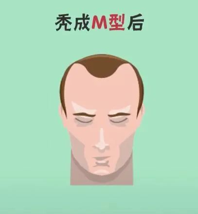 【吕虎"m"型脱发vs"o"型脱发,到底哪个更严峻?