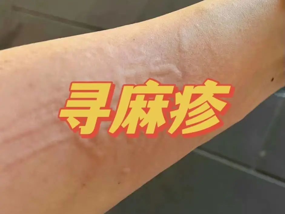 荨麻疹引起的原因揪出3大真凶还你光滑皮肤