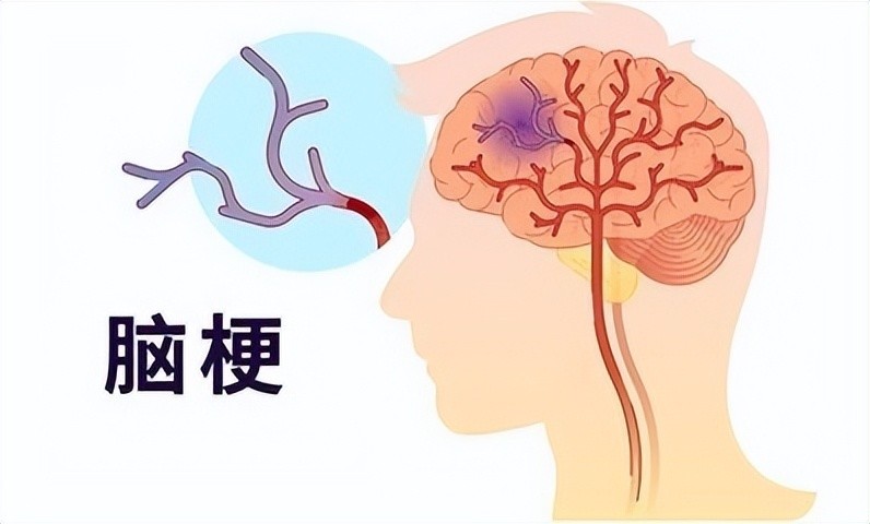 脑梗塞患者应该注意的五个事项